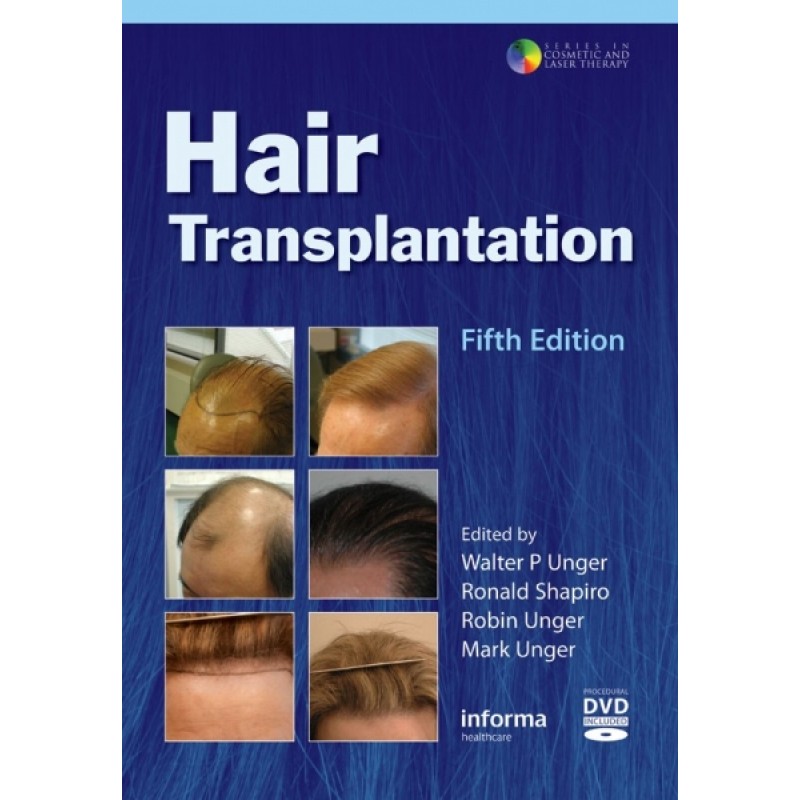 Hair Transplantation (with Procedural DVD), Fifth Edition